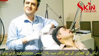 Acne scars treatment via Subcision by skin specialist Dr Syed Bilal Shams [upl. by Adnahs277]