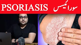 Dr ZeePsoriasis Treatment – The Best 3 Remedies for Psoriasis  सोरायसिस [upl. by Attayek]