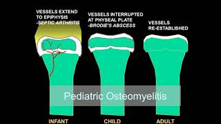 Imaging osteomyelitis acute and chronic [upl. by Sokcin991]