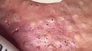 Blackheads amp Whiteheads Satisfying Removal 0275 [upl. by Azpurua]