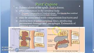 Pathology 825 h TB Spondylitis Tuberculous Osteomyelitis Potts Spine Disease disc body bone [upl. by Tsuda]