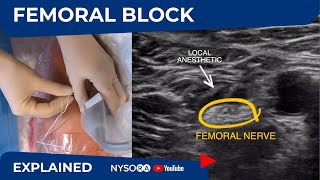 UltrasoundGuided Femoral Nerve Block  Regional anesthesia Crash course with Dr Hadzic [upl. by Fisken507]