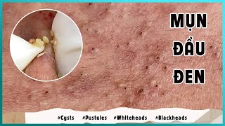 Big Cystic Acne Blackheads Extraction Blackheads amp Milia Whiteheads Removal Pimple Popping [upl. by Cathlene349]