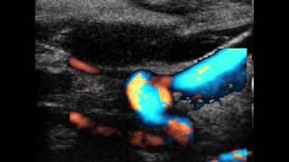 INTERNAL CAROTID ARTERY SPONTANEOUS DISSECTION [upl. by Ekalb]