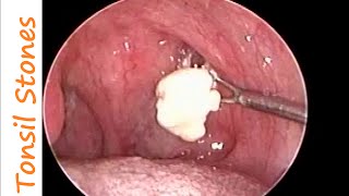 Huge Tonsil Stones Removal in a case of Chronic Tonsillitis amp Allergic Rhino Sinusitis [upl. by Nakeber]