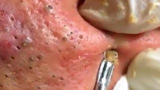 How To Remove Blackheads And Whiteheads On Face Easy 121 ✦ Dr Laelia ✦ [upl. by Malchy]