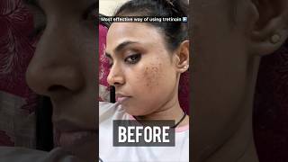 How to use Tretinoin Cream for most effective results Tretinoin before and after skin ✨shots [upl. by Altheta]