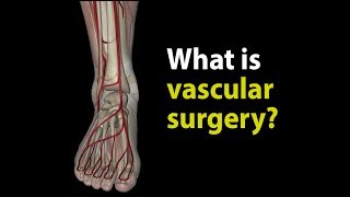 What is vascular surgery [upl. by Whitver]