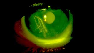 Fluorescein eye stain [upl. by Amiaj]