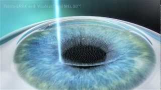 Montpellier opération laser LASIK myopie Docteur Coullet [upl. by Ailehpo573]