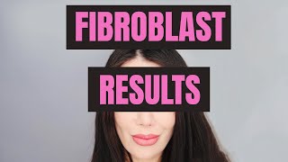 Fibroblast Treatment Results [upl. by Euqinmod850]