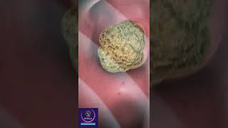 Kidney Stones Demolished  Treatment With Shock Wave Lithotripsy [upl. by Hadihsar]