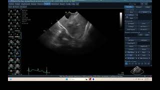 IQ 298 TFAST LUNG MEDIASTINAL LYMPHOID NODE ENLARGEMENT HWD ECHOPAC ANALYSIS [upl. by Attelocin954]