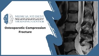 Osteoporotic Compression Fracture [upl. by Hanoj]