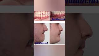 Before and After Orthodontic Treatment dentist bracing music dentalproblem openbite dentistry [upl. by Malet245]