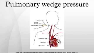 Pulmonary wedge pressure [upl. by Llewellyn502]