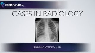 Cases in Radiology Episode 3 pediatric chest xray [upl. by Arinayed]