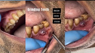 GRINDING TEETH  AbrasionErosion Attrition [upl. by Elag998]