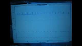 DIY ECG prototype 3 [upl. by Ceporah]