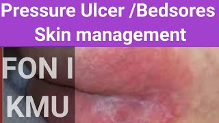 Bedsores  pressure ulcer skin management FON l KMU new 2024 [upl. by Nuarb]