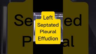 Septated Pleural Effusion  Lung Fluid  Dyspnoea ultrasound [upl. by Dihsar]