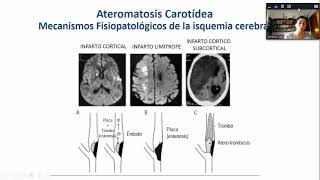 Ateromatosis carotidea [upl. by Oibirot]