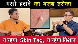 Skin Tags या मस्से हटाने का तरीका  Skin tags removal without surgery  Homeopathy  Himanshu Bhatt [upl. by Okimuk5]