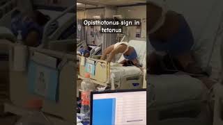 Tetanus opisthotonus sign  medico motivation medicalcollege nursing medicines icu hospital [upl. by Onitsuaf]