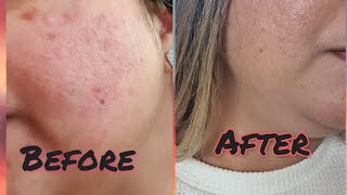 Kallistia Hormonal Acne Cleanse Capsules and Hyperpigmentation Capsules Review Before and After [upl. by Ladnar]