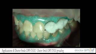 Doctor Smile Dental Laser whitening LWS TiO2 Whitening [upl. by Roxane]