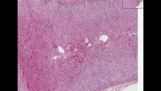 Histopathology AdrenalCortical adenoma [upl. by Godfrey276]