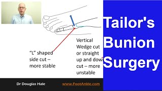 Tailors Bunion Surgery  Seattle Podiatrist [upl. by Olenka121]