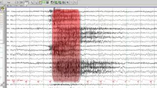 EEG in Juvenile Myoclonic Epilepsy [upl. by Alderson986]