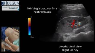 Episode 39 NephroUrolithiasis [upl. by Tebasile]