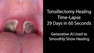 Healing Time Lapse After Tonsillectomy 029 Days in 60 Seconds [upl. by Vescuso425]