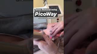 Tattoo Removal  Candela Picoway Laser [upl. by Florie]