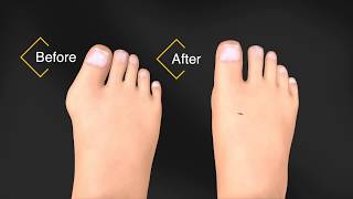 Before and After Bunion Surgery Recovery [upl. by Tegdirb262]