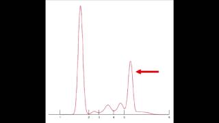 Monoclonal Gammopathy of Undeterminded Significance MGUS [upl. by Allebasi]