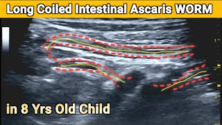 Ultrasound  Long  Coiled Ascaris Worm  in Small Intestine of 8yrs old Child [upl. by Garratt]