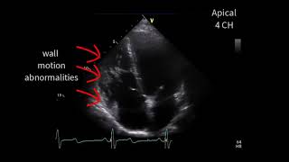 A special cardiomyopathy [upl. by Adnama]