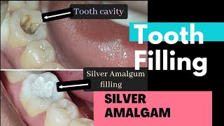 Tooth Filling  Silver Amalgam  Tooth Cavity Filling Material [upl. by Atihana37]