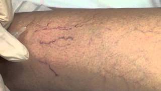 Spider Vein Sclerotherapy [upl. by Dihahs]