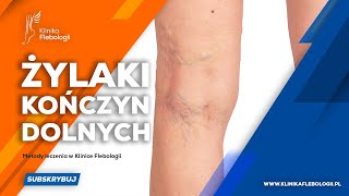 Żylaki kończyn dolnych  metody leczenia [upl. by Lamraj]