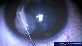 INTRACORNEAL SEGMENT REMOVAL [upl. by Kali4]