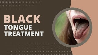 Black Tongue Treatment 2 Effective Ways To Prevent It [upl. by Rauscher106]