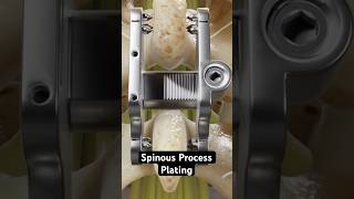 Spinous process plating for a stronger backbone 3D Animation [upl. by Jueta931]