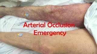 Acute Complete Occlusion of the Leg Arteries [upl. by Perkoff]