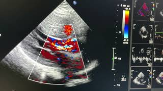 Hypertrophic Cardiomyopathy Non obstructive [upl. by Azirb]