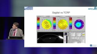 Pentacam® AXL – Clinical Results [upl. by Anitsrhc403]