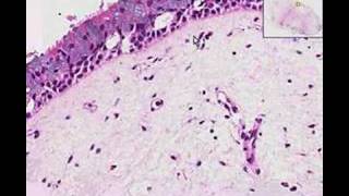 Histopathology Nose Nasal polyp [upl. by Leaper]